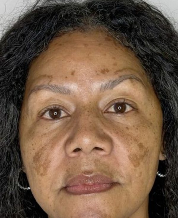 Pigmentation - Before
