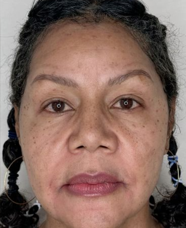 Pigmentation - After