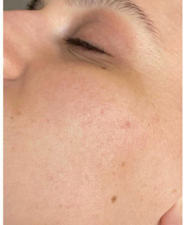Acne - After