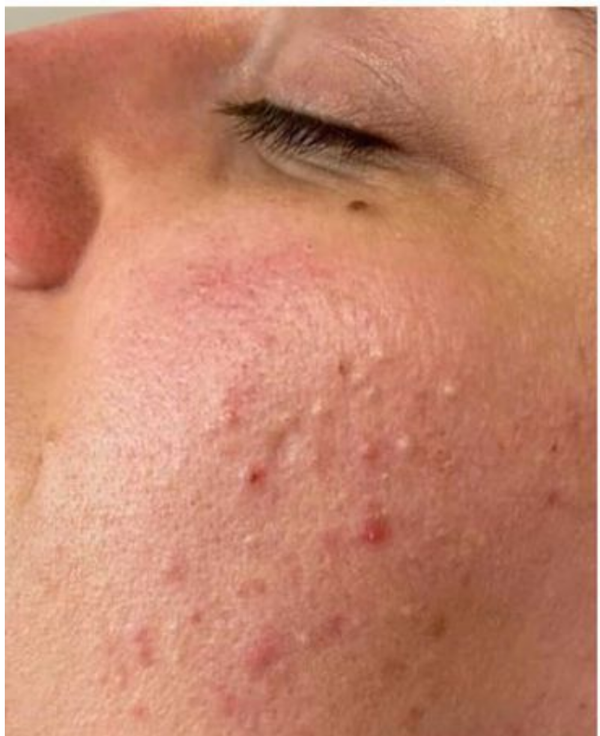 Acne - Before