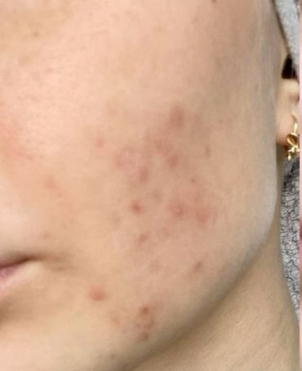 Dull & Tired Skin - Before