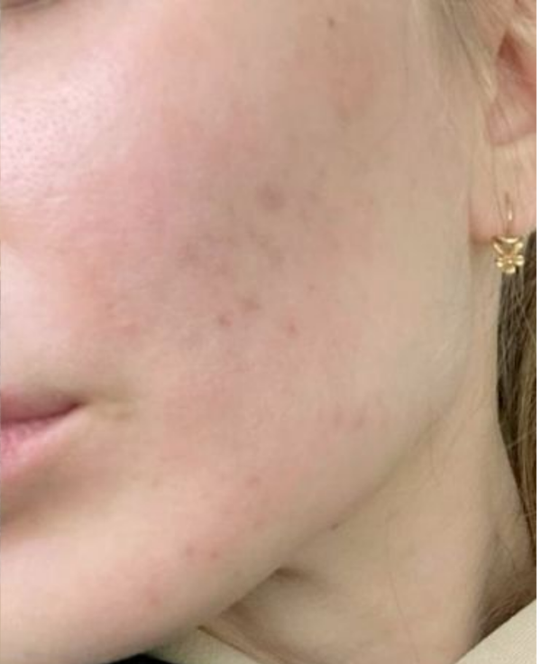 Dull & Tired Skin - After
