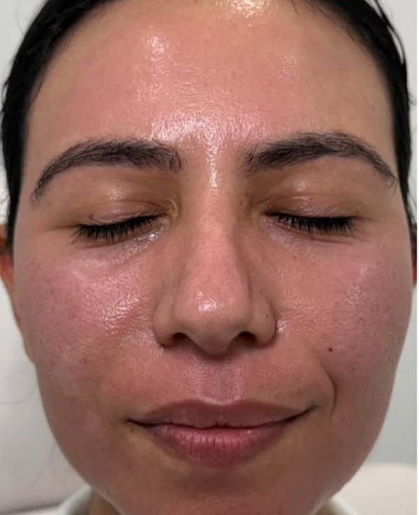 Dull Skin - Before