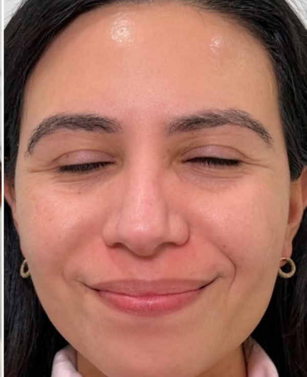 Dull Skin - After